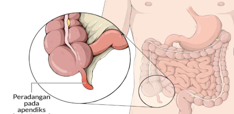 Mencegah Pembengkakan Usus Besar Yang Menyakitkan