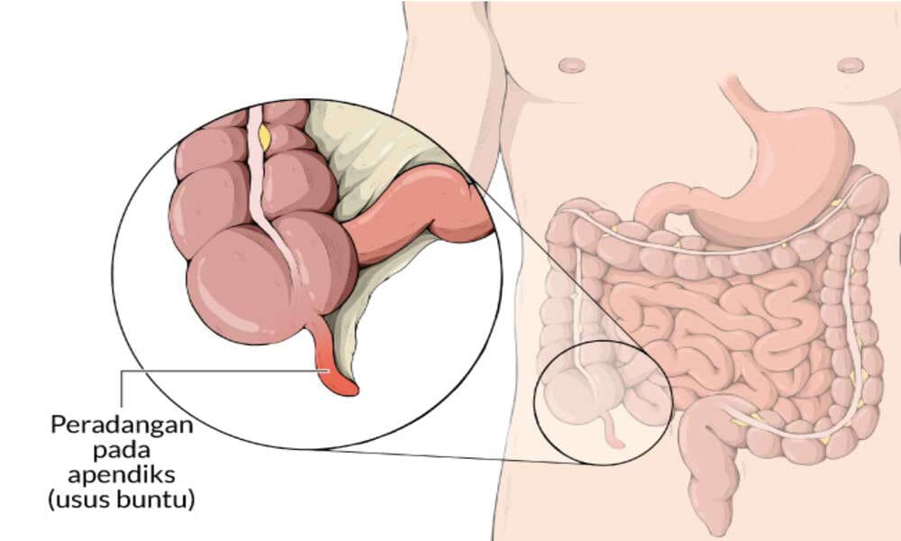 Mencegah Pembengkakan Usus Besar Yang Menyakitkan