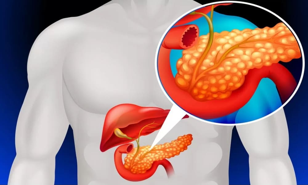 Mencegah Rusaknya Pankreas Untuk Menjaga Pencernaan